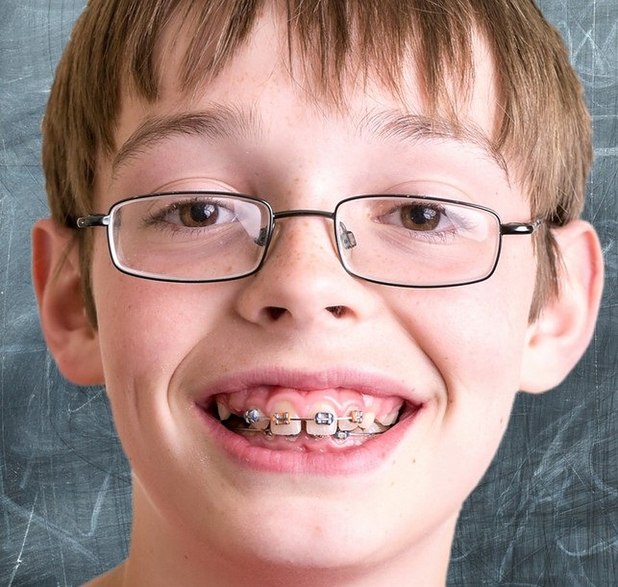 The History of Braces - Everything to Know