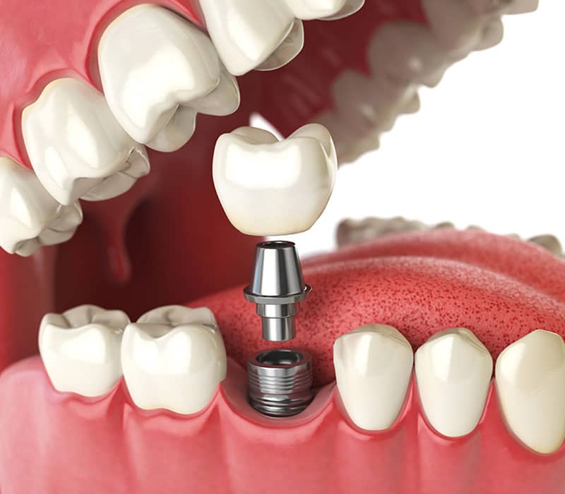 Dental Implants in Vaughan, ON