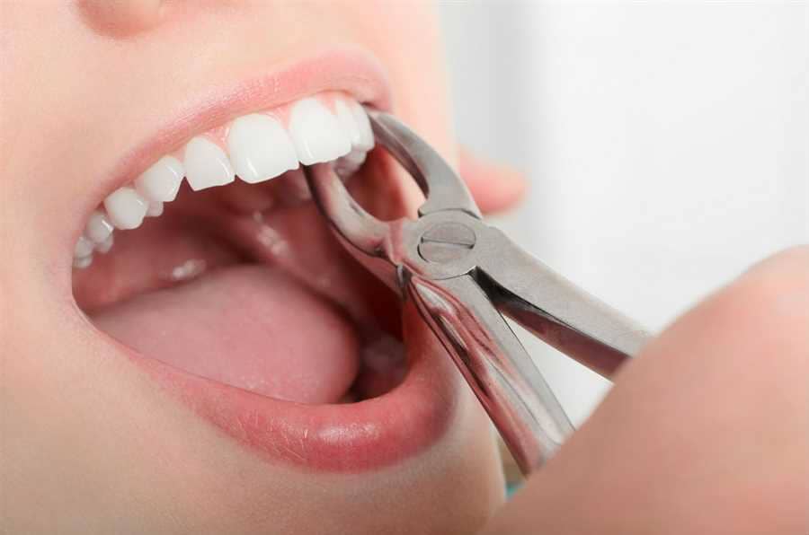 Tooth Extraction in Vaughan, ON
